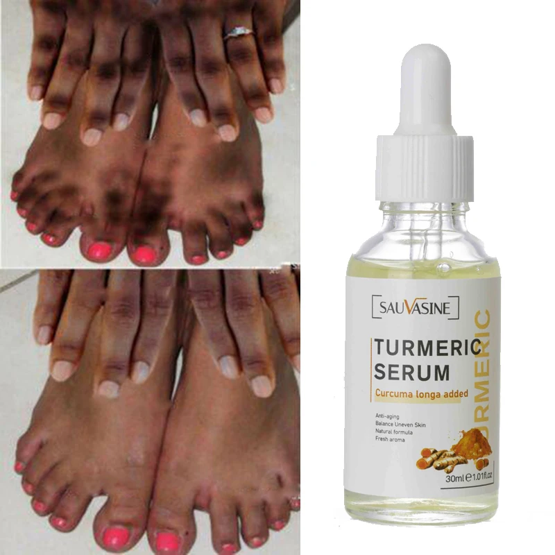 

Turmeric Lemon Oil Skin Glow To Lightening Acne Dark Patches, Acne Bright Skin Dark Spot Corrector Face Whitening Serum