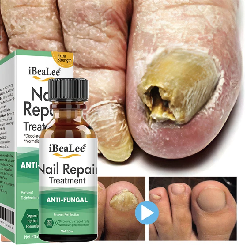 

Fungal Nail Treatment Serum Anti-infective Onychomycosis Gel Toe Nails Fungus Removal Essence Remedy Cream Hand Foot Repair Care