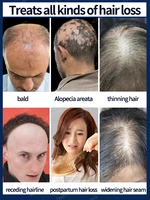 Fast Hair Growth Hair Follicle Treatment Hair Growth Seborrheic Alopecia Hairline Upward Postpartum Hair Loss Baldness Hair Loss 3