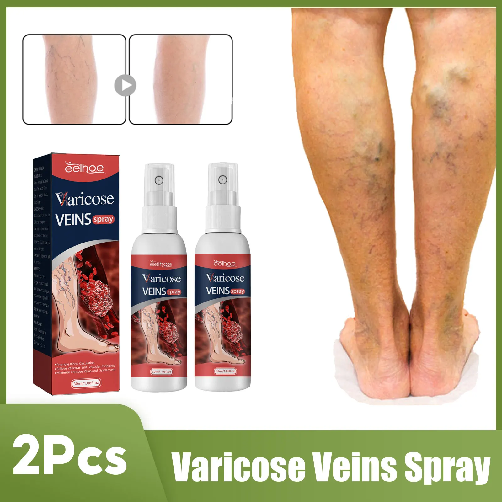 

Varicose Veins Spray Phlebitis Vasculitis Treatment Repair Remove Spider Legs Soothing Pain Swelling Promote Blood Circulation