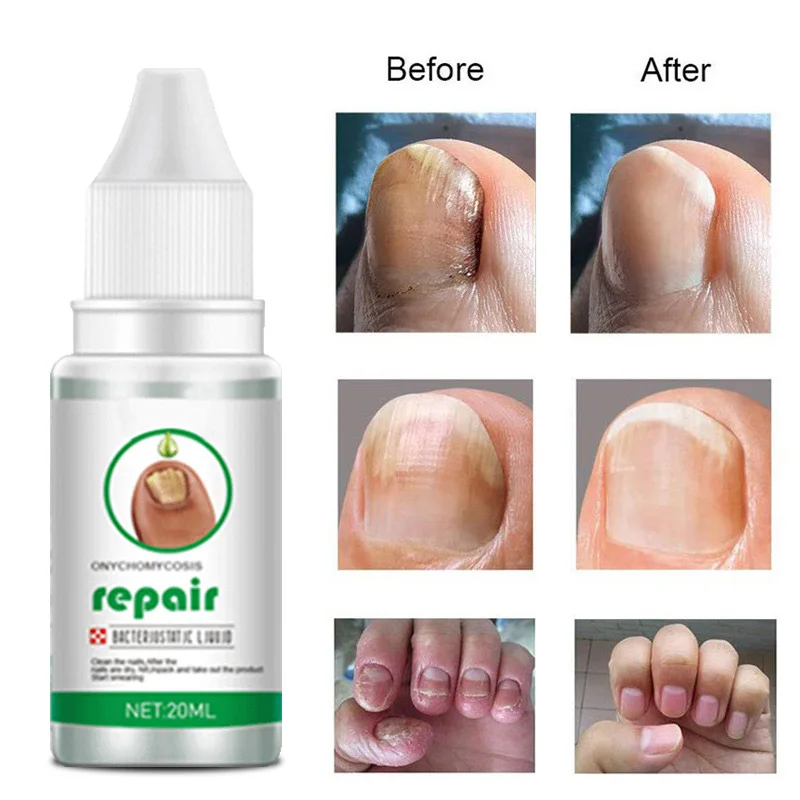 

Nail Fungus Treatment Serum Toe Fungal Repair Products Hand Foot Care Removal Gel Anti Infection Onychomycosis Paronychia
