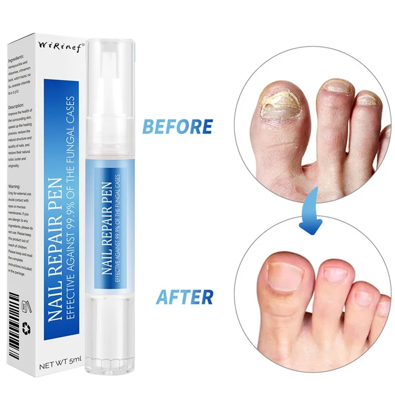 Nail Fungal Repair Liquid Pen Onychomycosis Paronychia Anti Infection Toe Fungus Hand Foot Removal Repair Gel Nail Fungus Serum