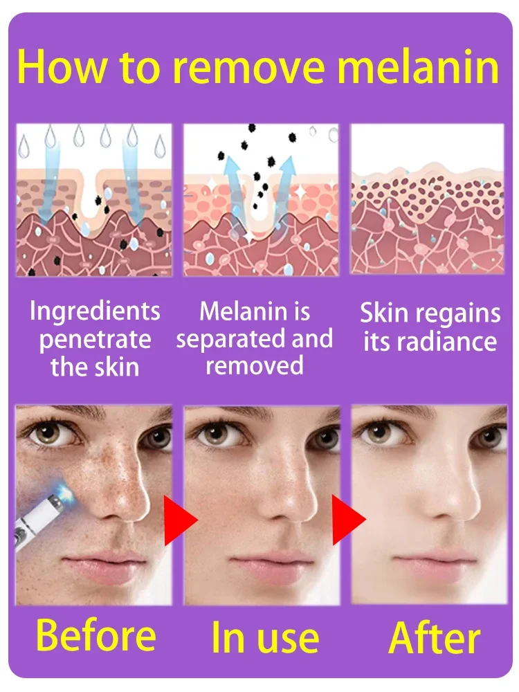 Sun Dark Age Spot Веснушки Прозрачные