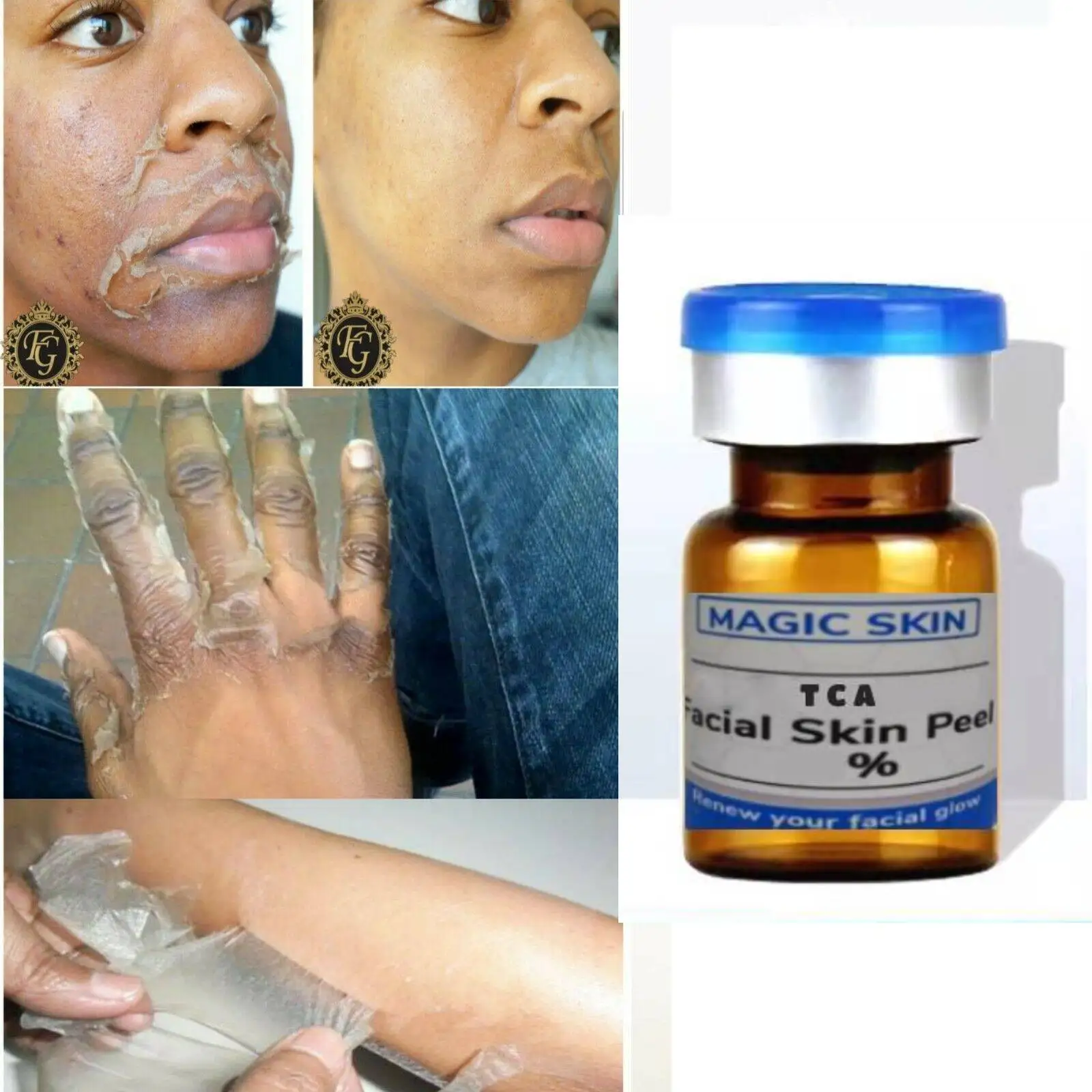 tca chemical peel 30 Medium Depth Chemical Peel PURE Pharmaceutical Medical Grade |