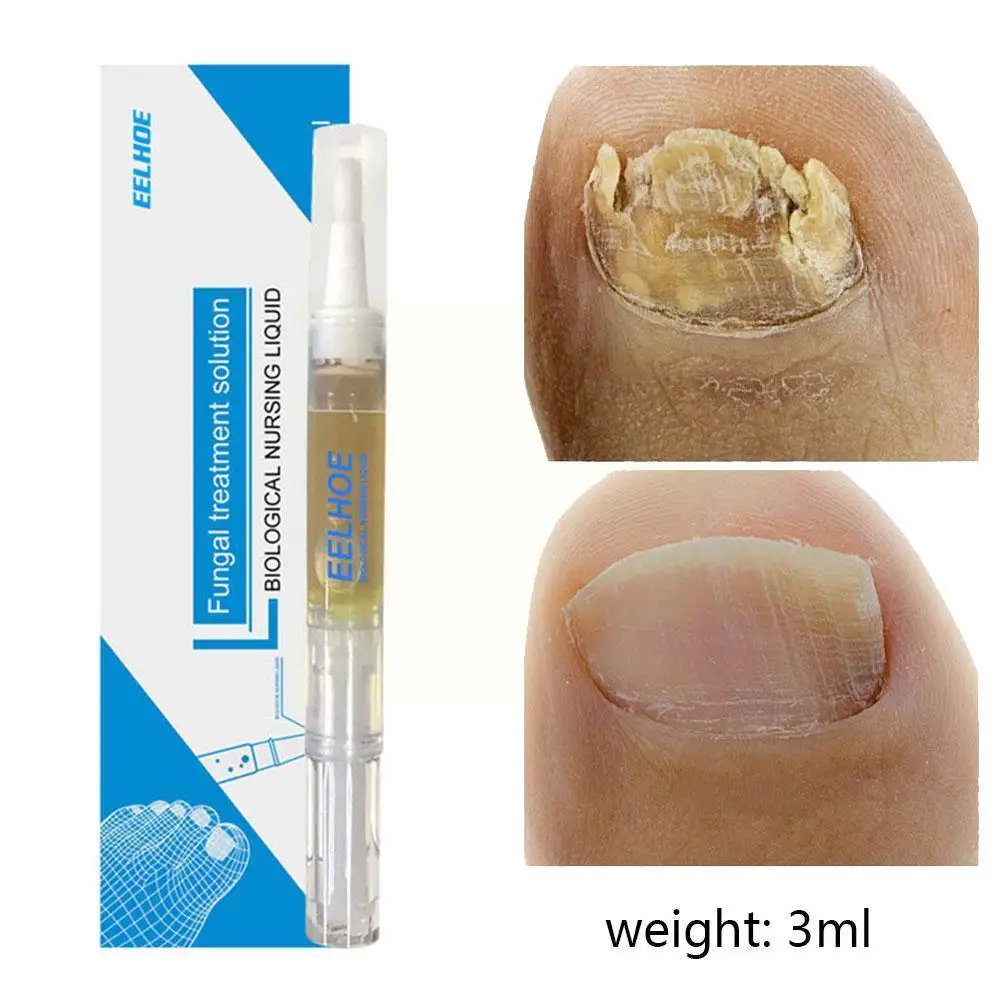 

Nail Fungal Treatment Pen Anti Fungus Infection Biological Repair Toenails Oil Restores 3ml Healthy Solution Nutritious E3E8