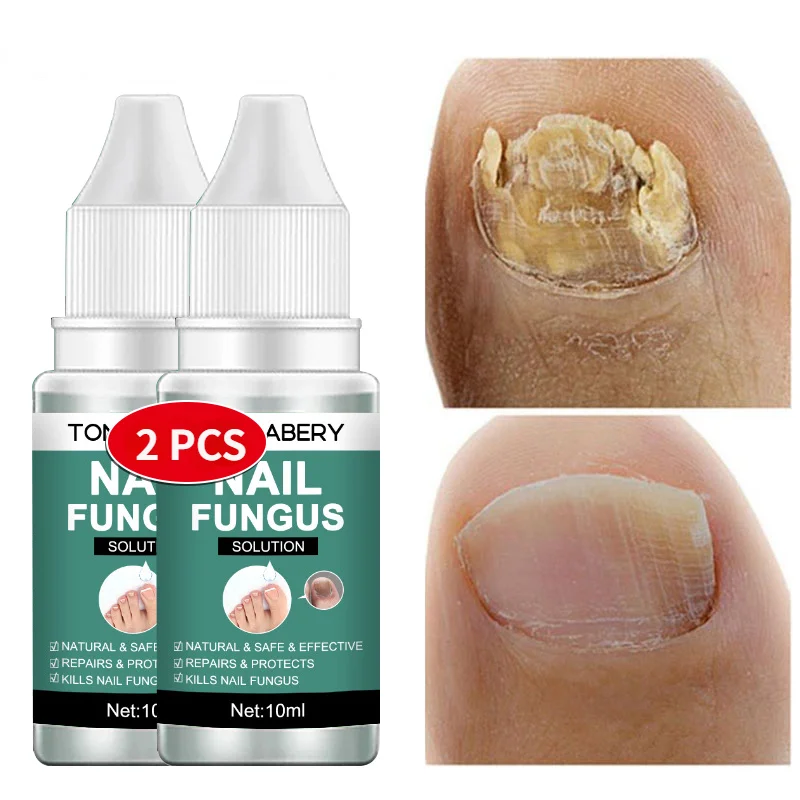 

2-1PC Nail Fungal Treatment Essence Feet Care Serum Anti Infection Paronychia Onychomycosis Foot Toe Nail Fungus Removal Product
