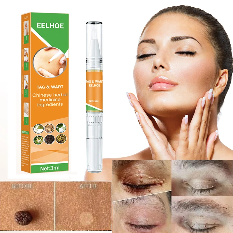 

3ML Skin Tag Remover Pen Against Mole & Genital Wart fast Remover Removal Papillomas Rapidly Removes Mole Anti Foot Corn