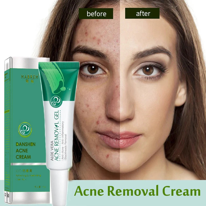 

Aloe Acne Treatment Gel Face Cream Serum Anti Acne Scar Cream Shrink Pores Moisturizing Oil Control Soothing Essence Skin Care