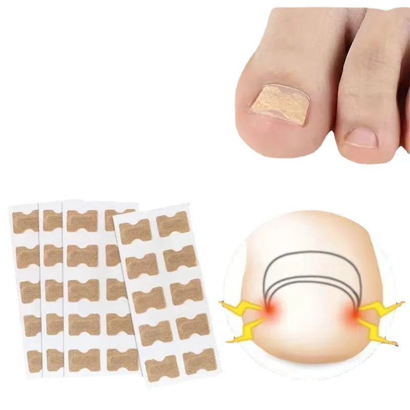 

10-50 шт., корректирующие наклейки для вросших ногтей