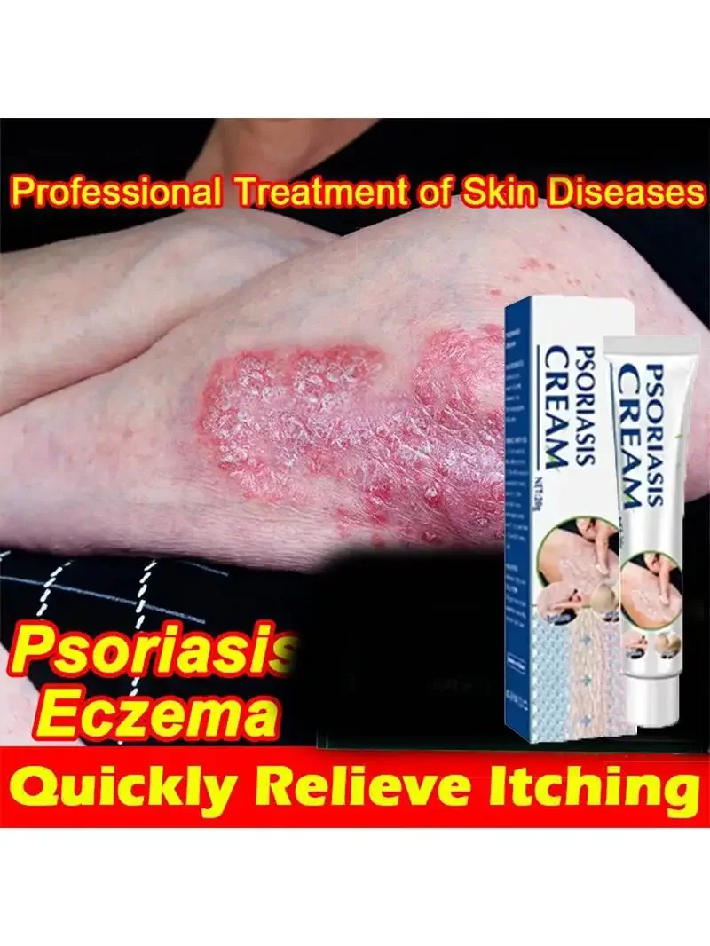 Антибактериальный крем от псориаза опояскивающий пенис экзема герпес