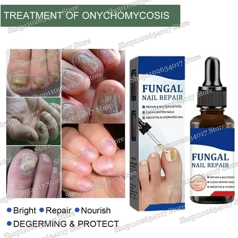Toenail Nail Fungus Treatment Repair Fingernail Device for Foot Essential Oil Onychomycosis Care