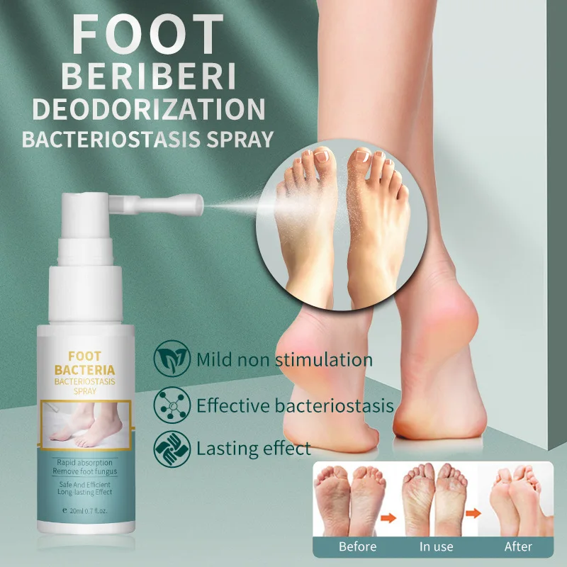 

Beriberi Spray Itchy Feet Smelly Sweaty Feet Foot Care Solution Beriberi Ointment Spray Foot Peeling Spray