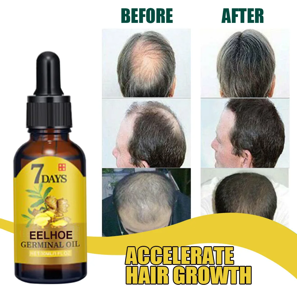 

10/15/20/40ml Ginger Hair Loss Treatment Fast Hair Regrowth Essential Oil Hair Loss Care Beauty Scalp Treatment For Men Women