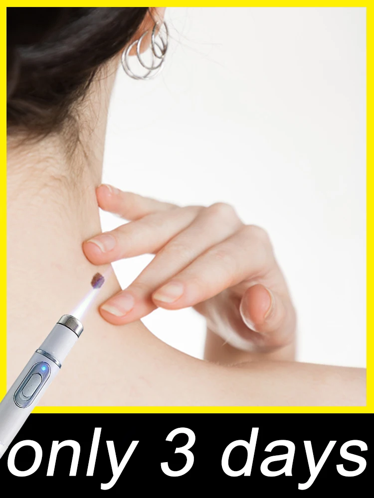 

Лазерная ручка для удаления бородавок excellence Portable Blue Light