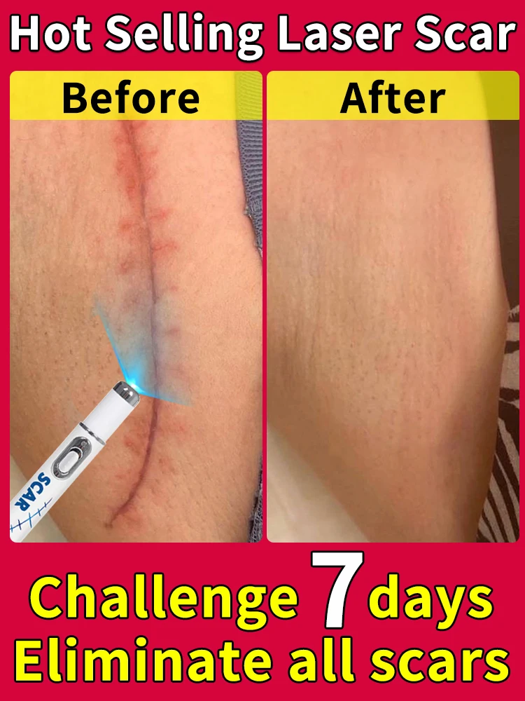 Хит продаж лазерный ремонт шрамов на коже