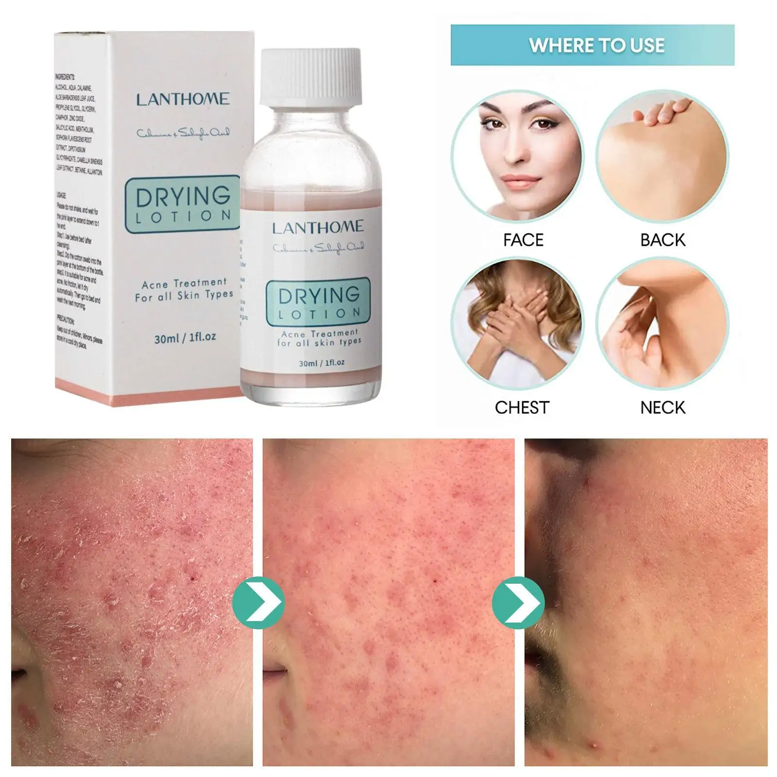 

Сыворотка для удаления прыщей, с салициловой кислотой