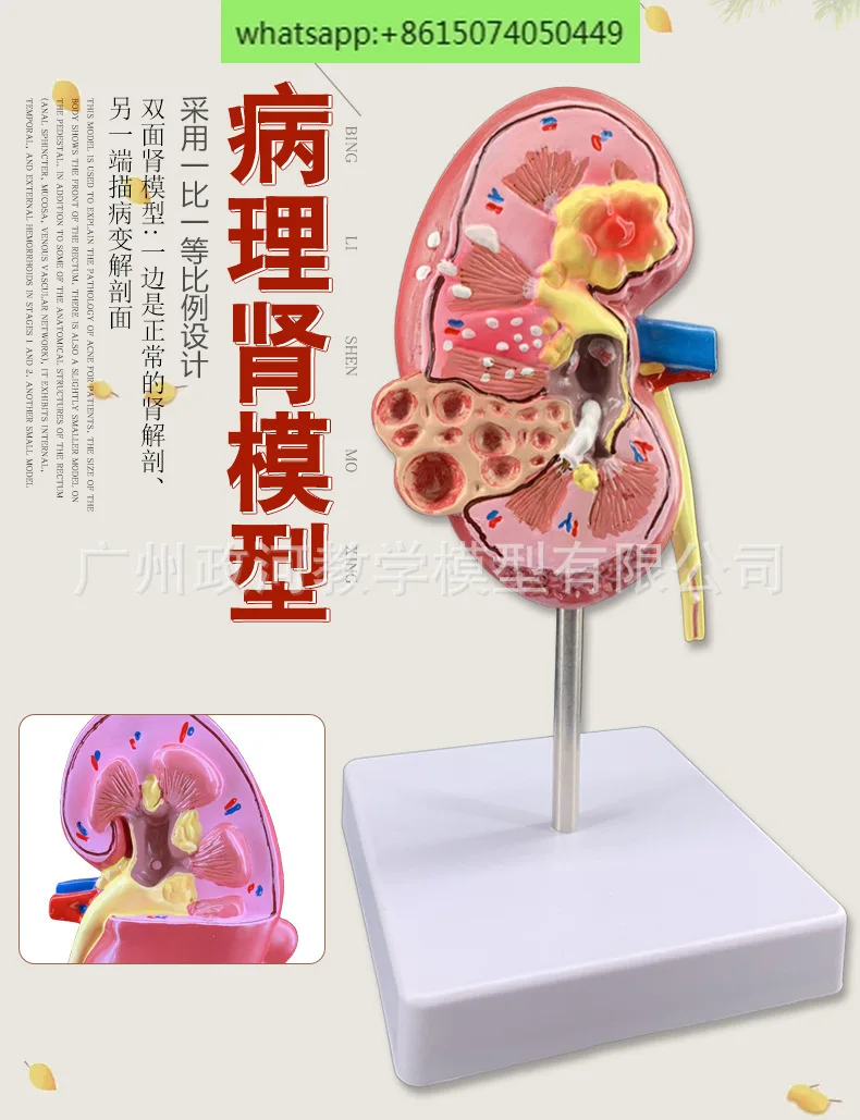 Моделирование обучения модель патологической почки образец почечной анатомии