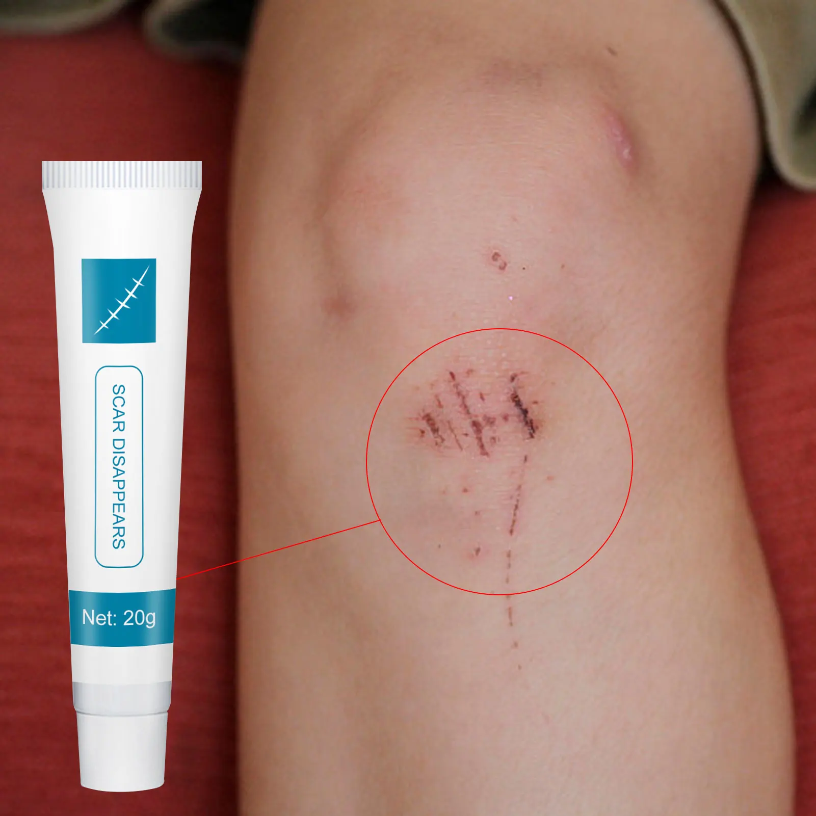 

Крем для удаления шрамов от растяжек, акне, пятен, ожогов и хирургических рубцов, уменьшение и ремонт шрамов на лице и теле