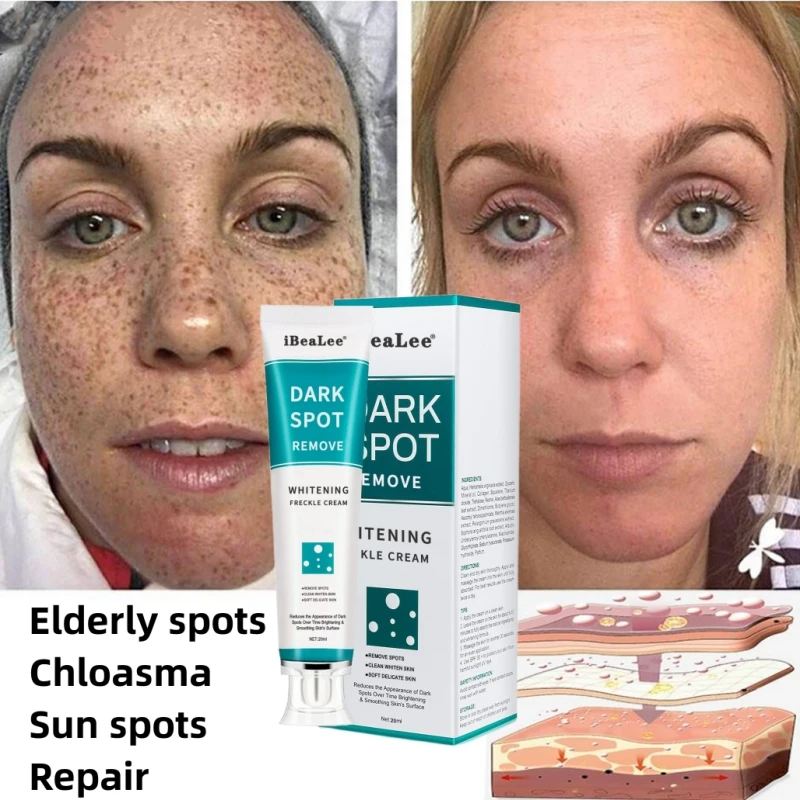 

Powerful Whitening Freckle Cream Dark Spot Corrector Remove Sunspots Melanin Pigmentation Melasma Brighten Smooth Face Skin Care