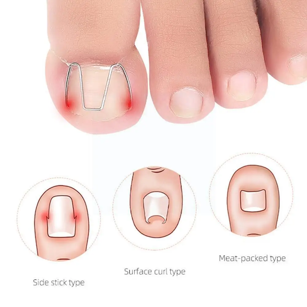 

3 пары передний крючок для ногтей/резиновая лента для дизайна ногтей вросший зажим для ногтей вросший ортопез для ногтей паронихия коррекци...