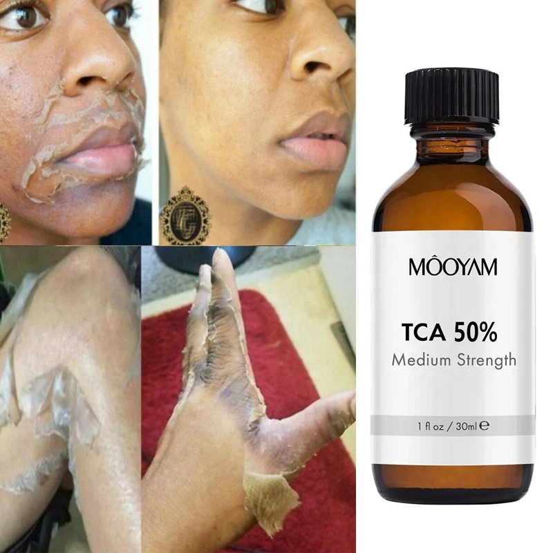 

50%TCA Chemical Peel Anti Aging Anti Wrinkle Peeling Serum for Repair Acne Scars Brightens Lightens Skin