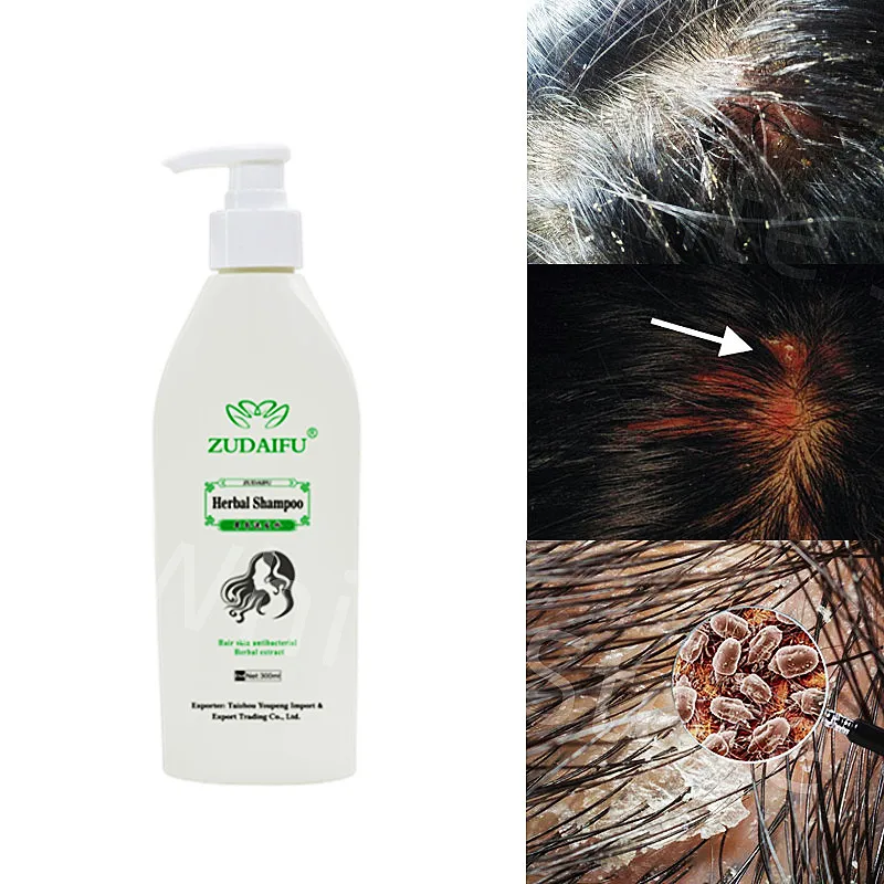 

Zudaifu Hair Psoriasis Seborrheic Skin Care Treatment Dermatitis Eczema Compound Herbal Shampoo Repair Scalp, Remove Dandruff