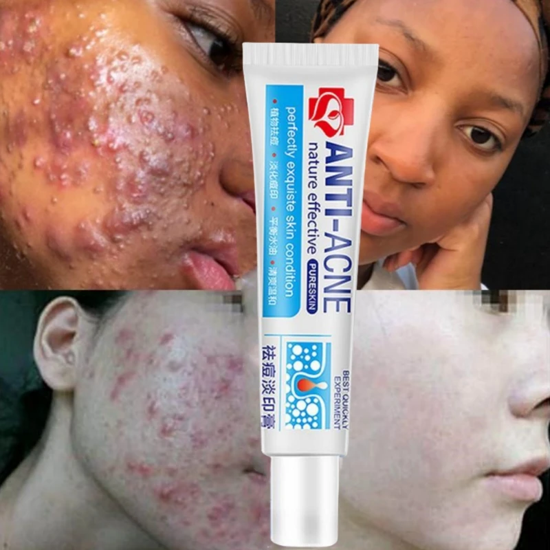 

New Powerful Acne Removal Face Cream Clears Pimple Scar Black Dots Gel Treat Severe Acne Shrink Pore Whiten Skin Care Ointment