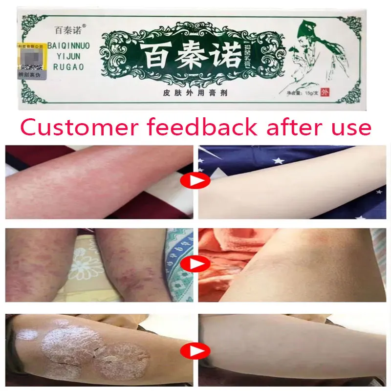 

Psoriasis Ointment Dermatitis, dermatitis cream Eczema cream Dermatitis Anti Fungal InfectionUrticaria
