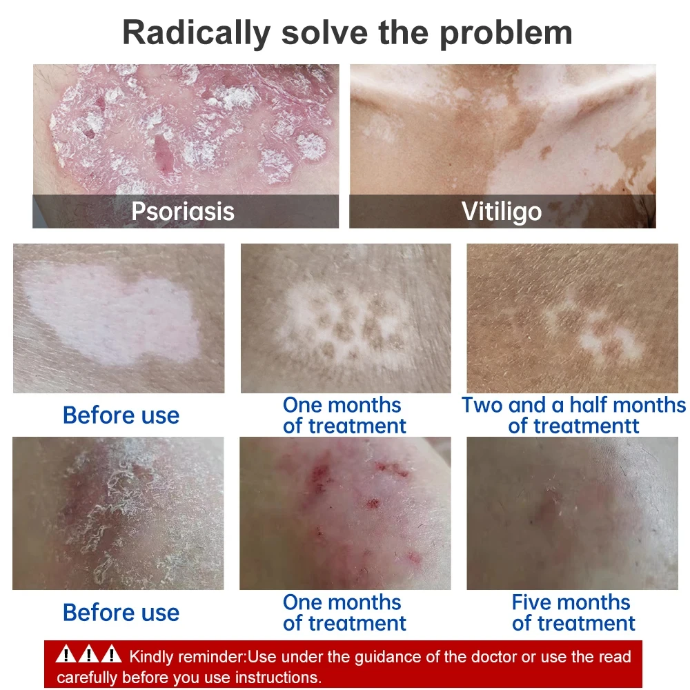 308nm Uvb Vitiligo лампа для лечения псориаза оборудование физической терапии экземы