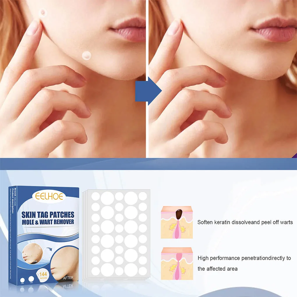 

Remove Patch Professional Warts Remover Antibacterial Patch Moles Removers