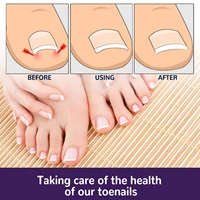 ingrown toenail corrector sticker paronychia treatment recover corrector bunion pedicure foot toe nail care tool