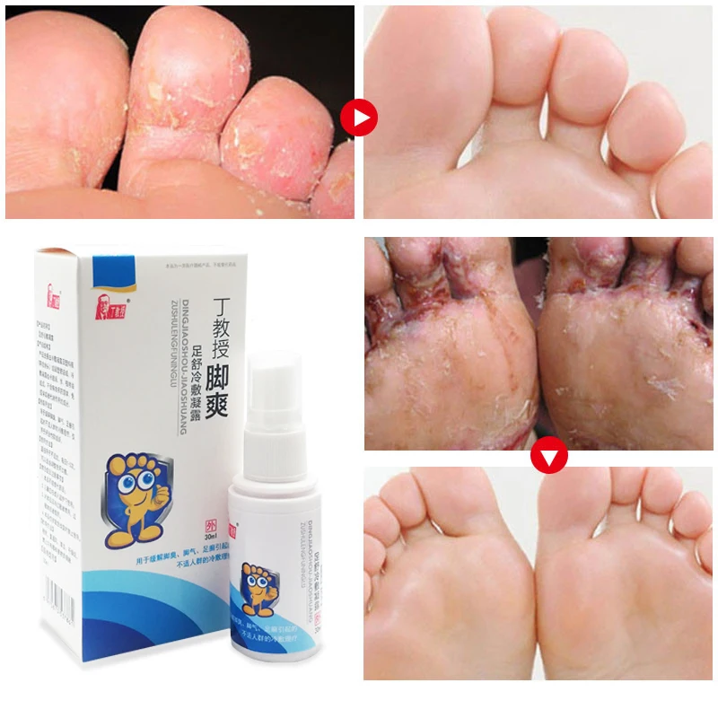 

1pcs Herbal Athlete Foot Anti-fungal Spray Remove Foot Odor Beriberi Itching Foot Care Repair Toe Ulceration Medical Spray