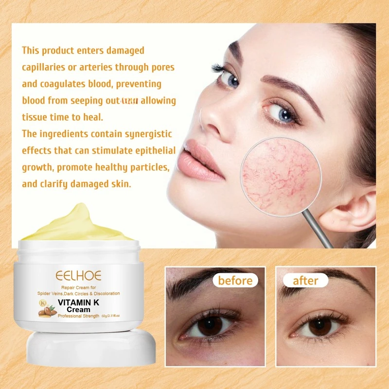 Крем с витамином K для лечения варикозного расширения вен флебит варикозное