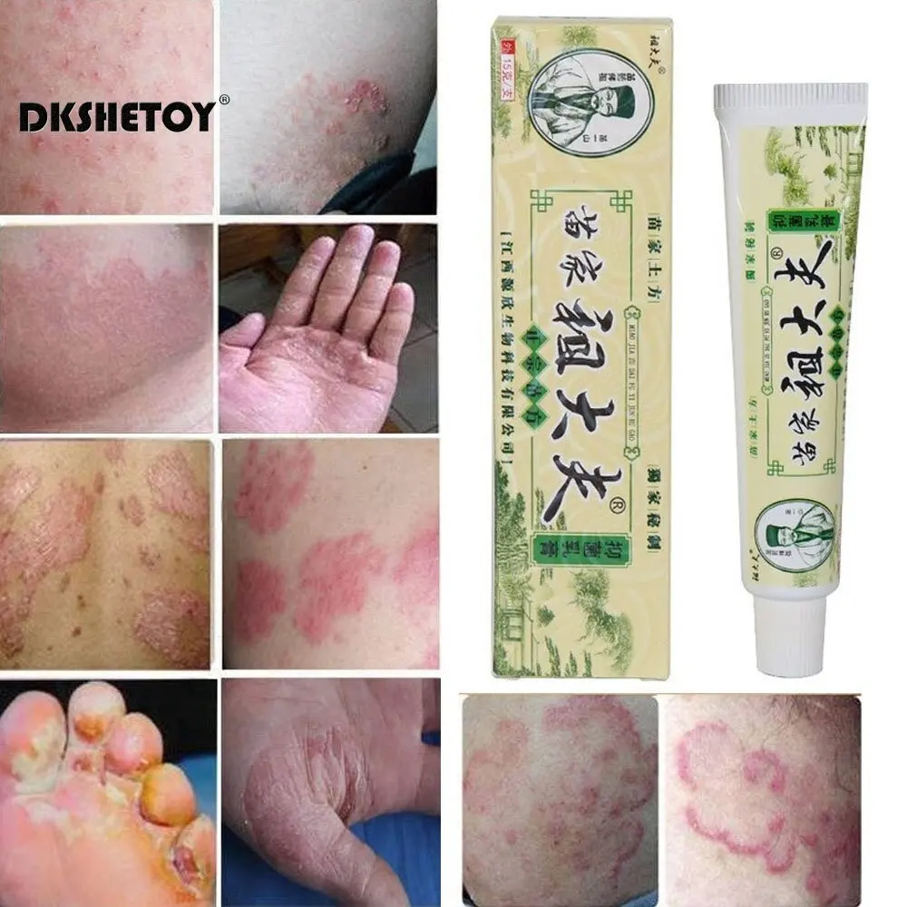 

Hypersensitivity Topical External Skin itching cream Herba Tinea Pedis Cream Maintenance Repair Fast Absorption medicine Plaster