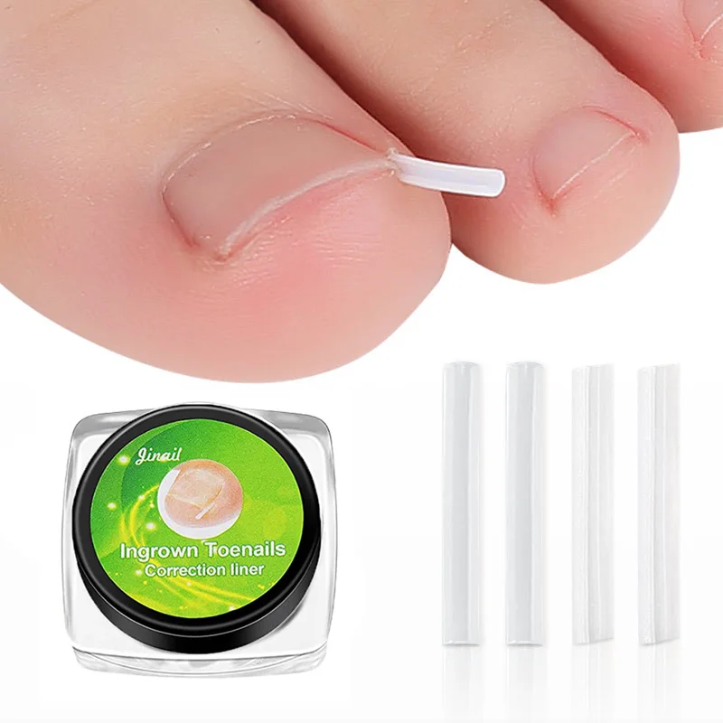 

10pcs Ingrown Toenail Correction Tool Ingrown Toe Nail Treatment Elastic Patch Sticker Straightening Clip Brace Pedicure Tool