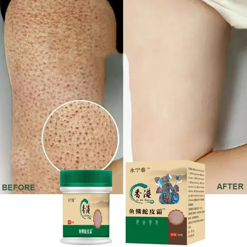 Крем для удаления куриной кожи крем тела восстановление кератоза пиларис грубые