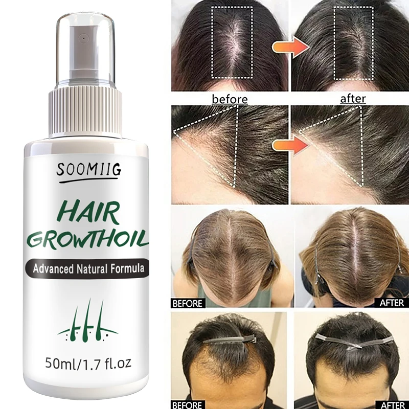 

soomiig Hair Growth Spray Serum Ginger Anti Hair Loss Fast Grow Essence Care Products Prevent Hair Dry Frizzy Hair Easy To Carry