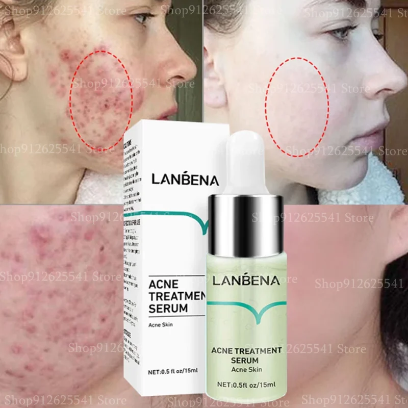 

Сыворотка для удаления акне, Удаление прыщей, сужение пор, салициловая кислота, эссенция для лица, уход за кожей для женщин и мужчин, контрол...