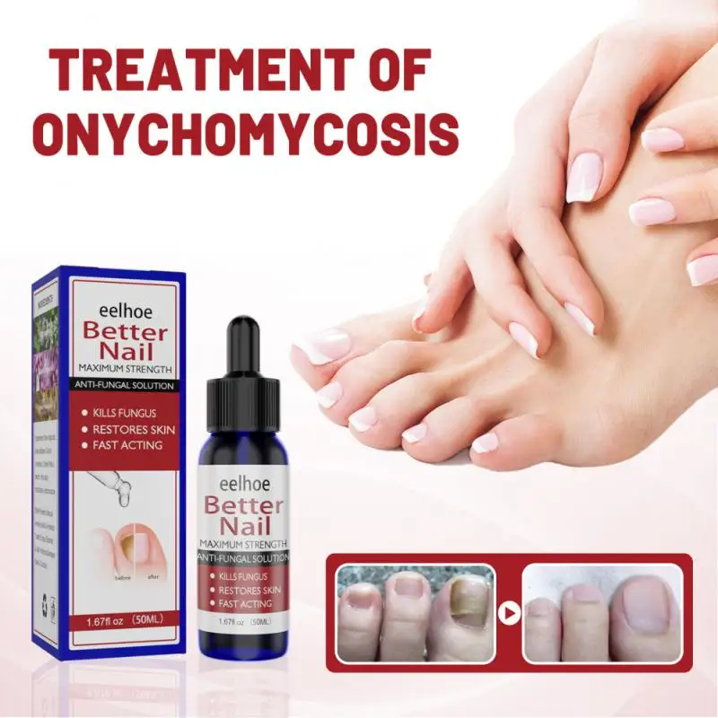 

Nail Fungus Treatment Essence Serum Care Hand And Foot Care Removal Repair Gel Anti-infective Paronychia Onychomycosis