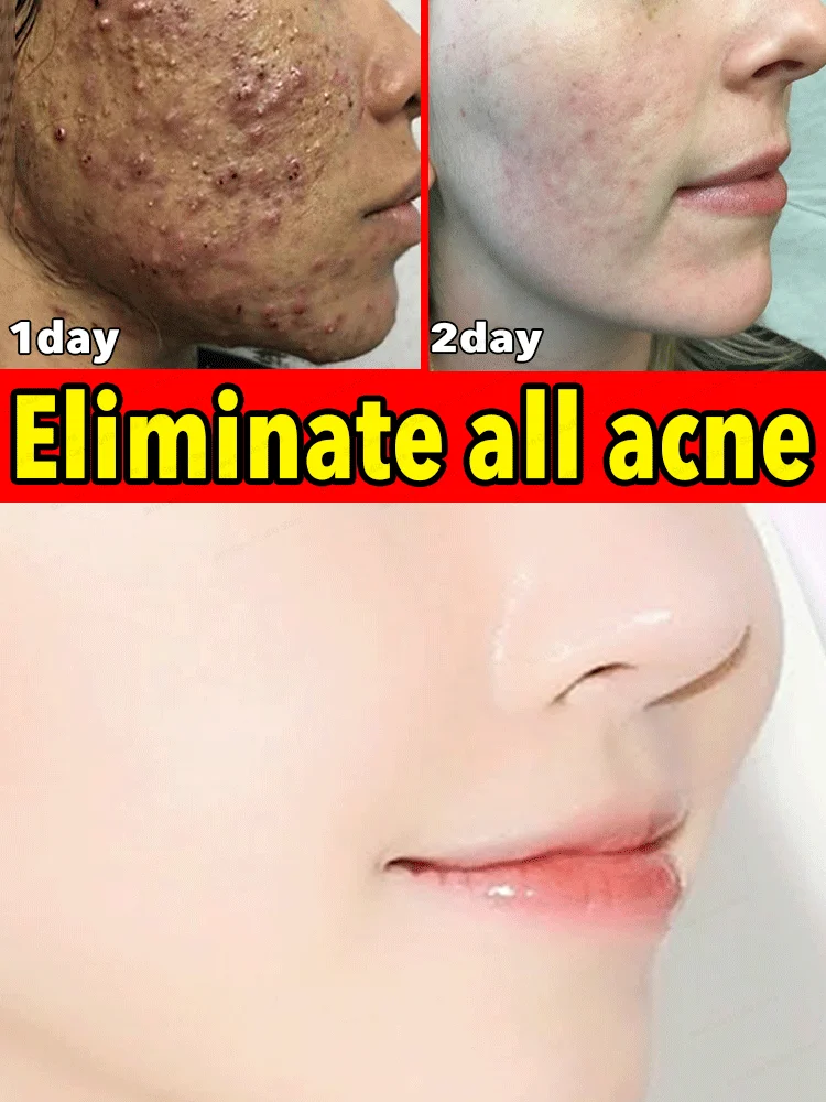 

Acne Treatment Cream For Face Scar Serum