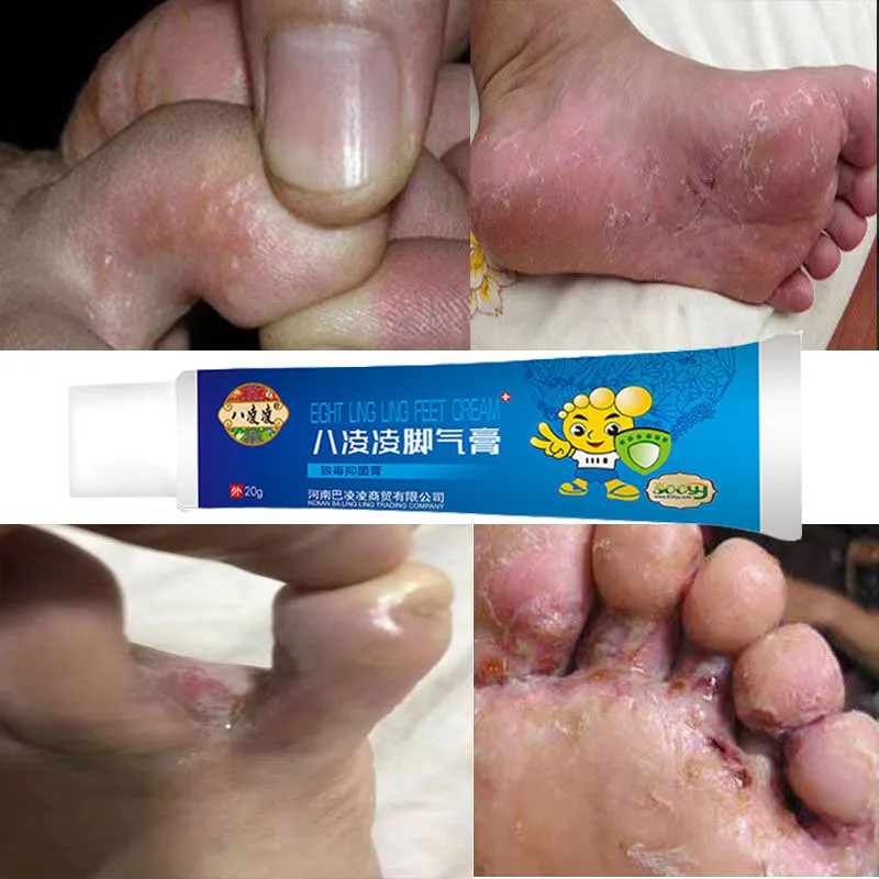 

Herbal Effective Foot Cream Treatment Anti Fungal Infection Onychomycosis Paronychia Toe Fungus Gel Repair Dry Crack Feet Care