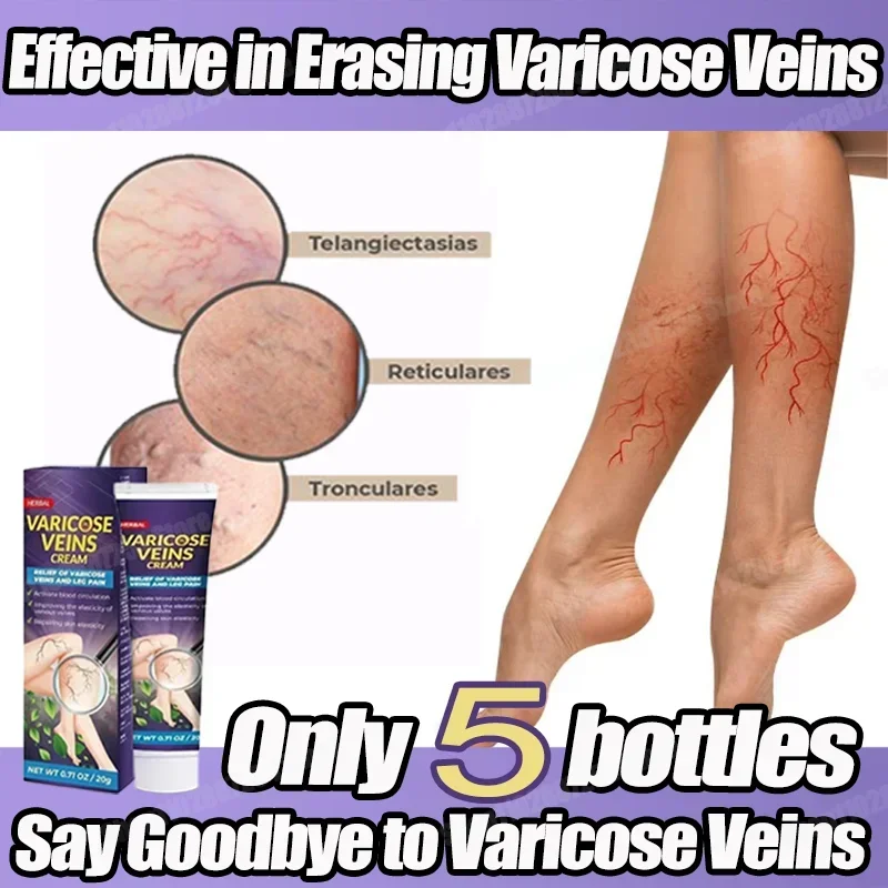 Varicose Veins cream Natural Herbal Skin Improved Blood Circulation Swelling Relief and Spider Vein Treatment