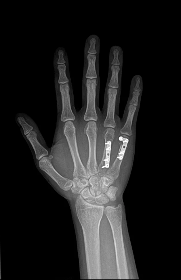 thumb