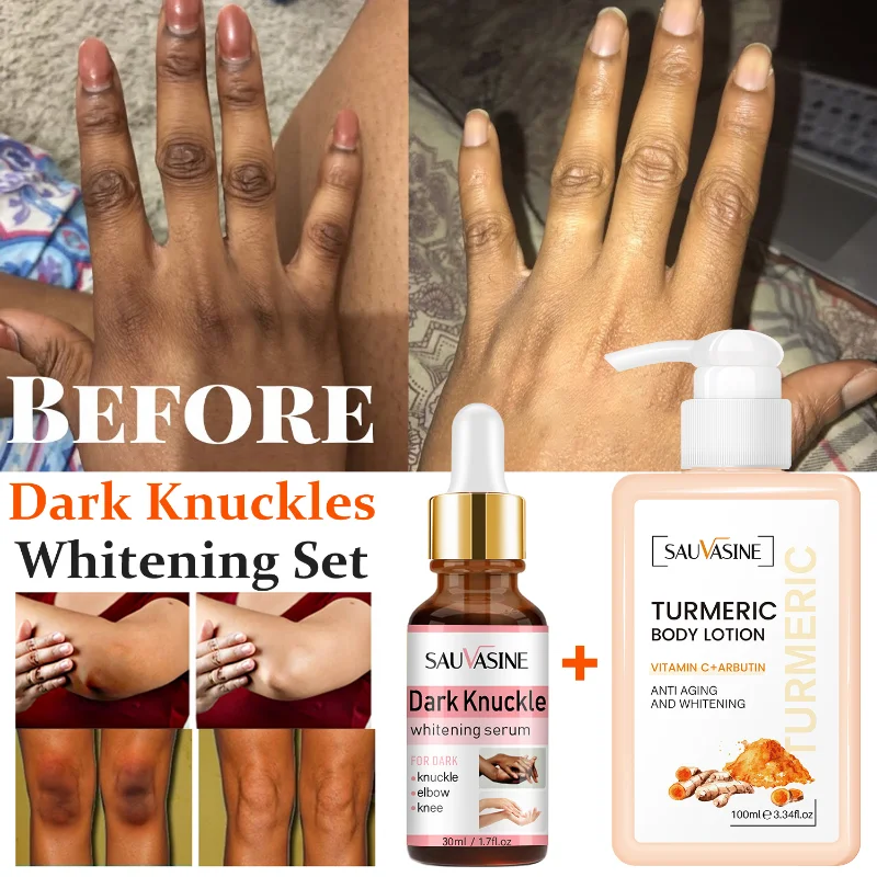 

2pcs Dark Knuckle Whitening Serum Turmeric Body Lotion Remove Dark Spots Brighten Hand Knuckle Elbow Knee Smooth Skin Lightening