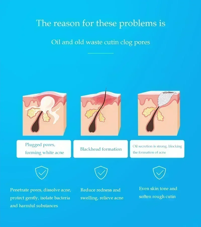 Лидер продаж раствор с салициловой кислотой эссенция 10 мл сужение пор и прыщей