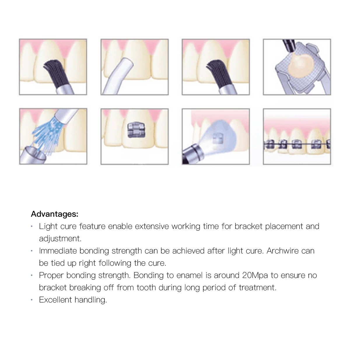 Набор стоматологических светоотверждаемых клеев ортодонтический материал для