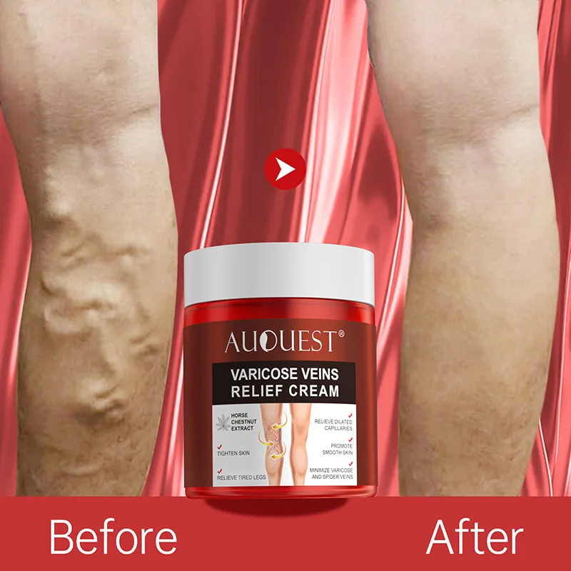 

AUQUEST Varicose Veins Relief Cream Vasculitis Phlebitis Spider Pain Relief Ointment Medical Plaster Body Care 80g