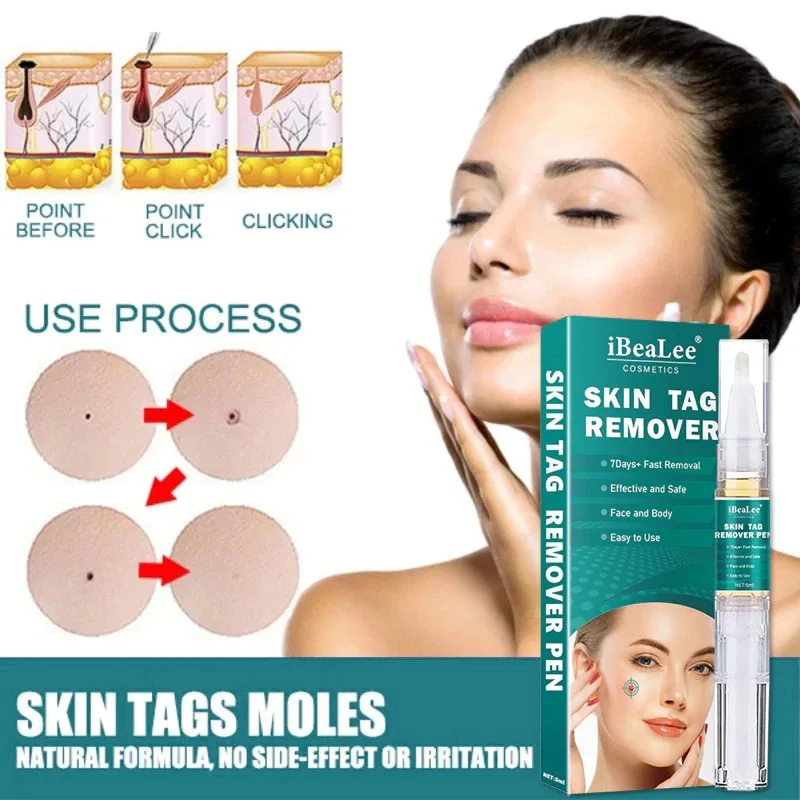 

Skin Tag Remover Against Mole & Genital Wart Fast RemovWithin Al Anti Foot Corn Removal Warts Papillomas Rapidly Removes Moles