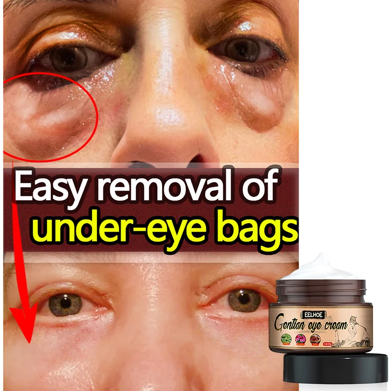 

Lightening Eye Fine Lines Eye Cream Removing Eye Bags Black Circles Edema Black Circles Eye Cream And Wrinkles Eye Cream
