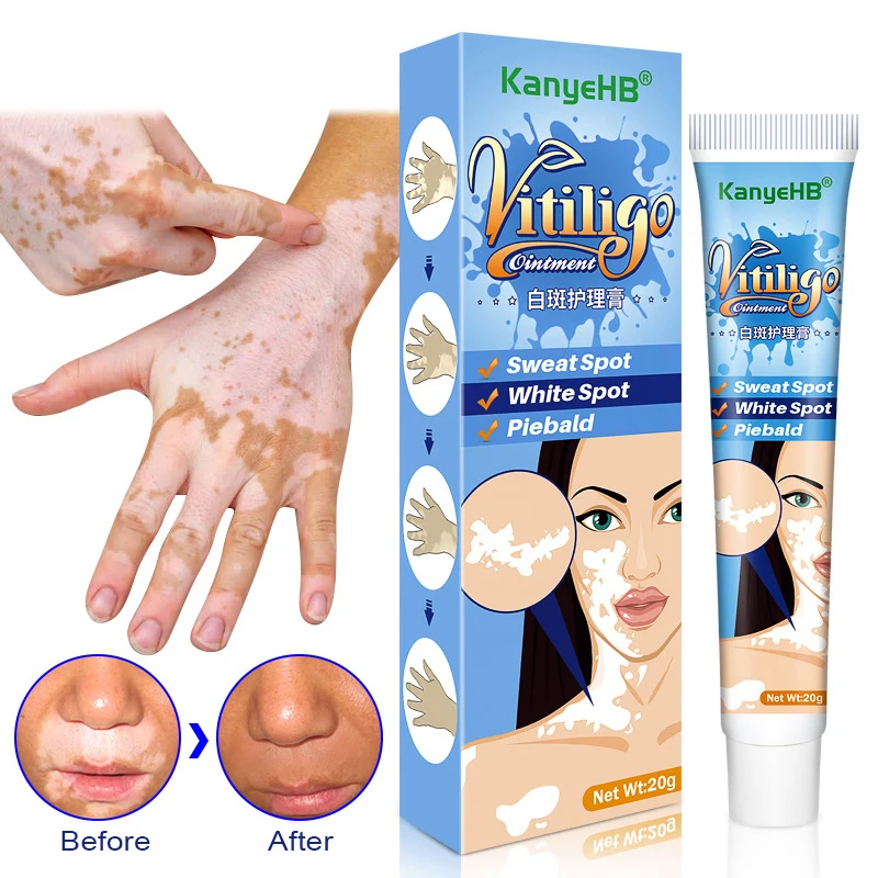 

20g Herbal Extract Vitiligo Ointment Remove Ringworm White Spot Removal Skin White Spot Leukoplakia Disease Treatment Cream